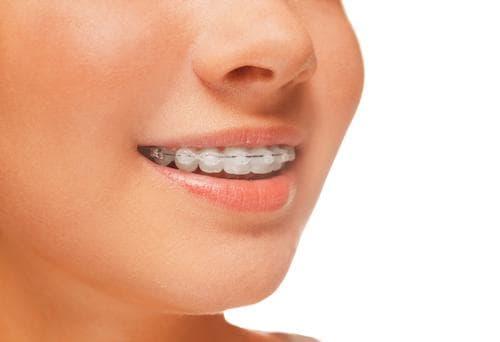 girl wearing traditional braces in wilmington ma