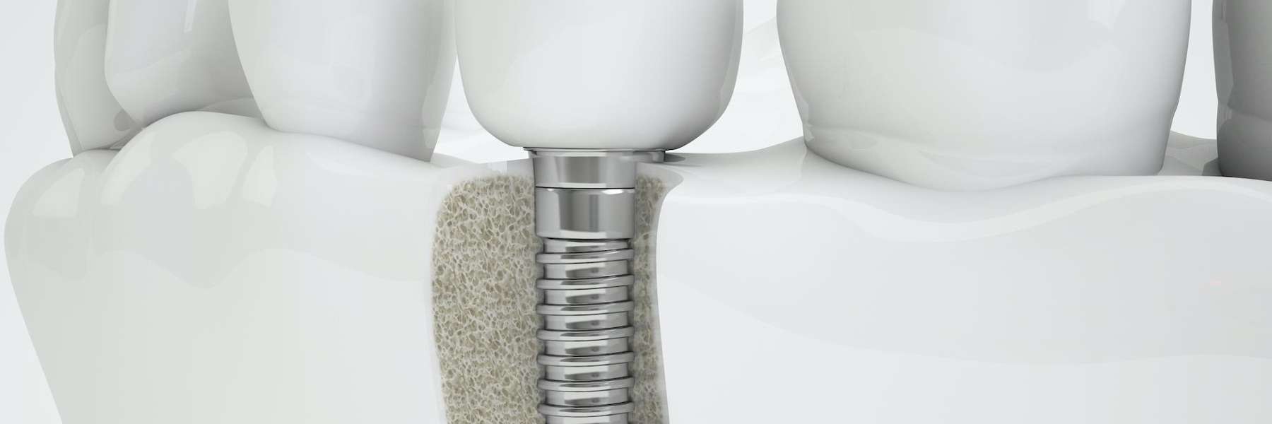 image of a dental implant in wilmington