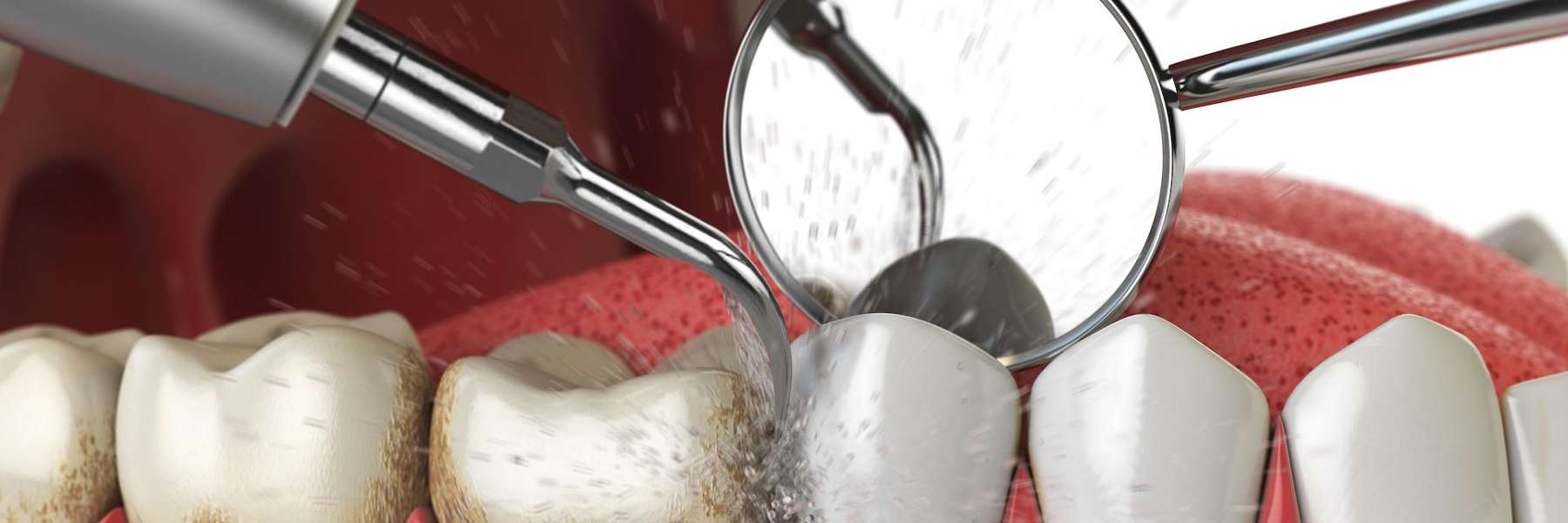 teeth cleaning in wilmington