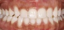 Six Month Smiles | Dentist in Wilmington MA