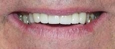After Ceramic Crowns | Dentist in Wilmington MA