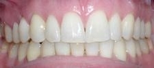 Invisalign-After-Image