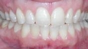 Invisalign-After-Image