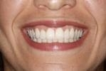 Six Month Smiles | Dentist in Wilmington MA