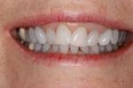 Teeth-Whitening-Deep-Bleaching-After-Image