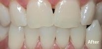 Teeth-Whitening-After-Image