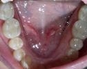 Tooth-Colored-Fillings-After-Image