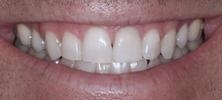 Veneers-After-Image