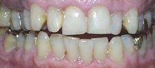 Before Ceramic Crowns | Dentist in Wilmington MA