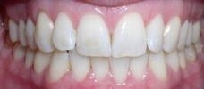 Invisalign-Before-Image