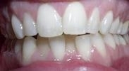 Invisalign-Before-Image