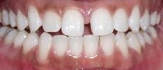 Six Month Smiles | Dentist in Wilmington MA