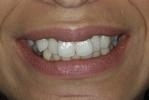Six Month Smiles | Dentist in Wilmington MA