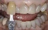 Teeth-Whitening-Deep-Bleaching-Before-Image