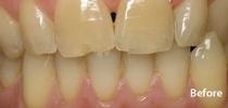Teeth-Whitening-Before-Image