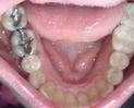 Tooth-Colored-Fillings-Before-Image