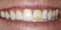 Veneers-Before-Image